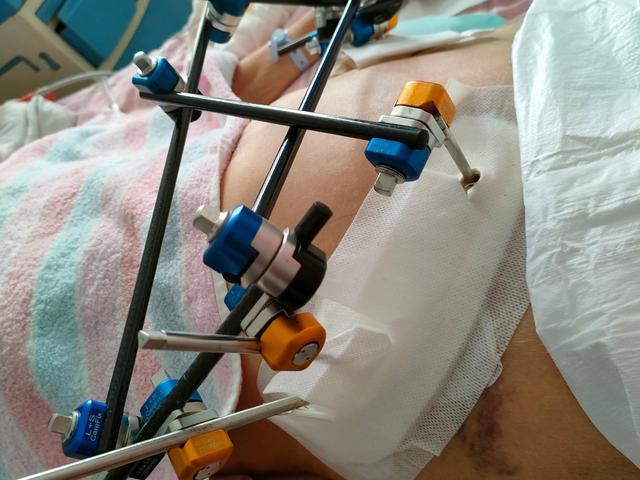 榆林市米脂县医院骨盆微创抢救技术取得重大突破死亡率显著下降(图1)